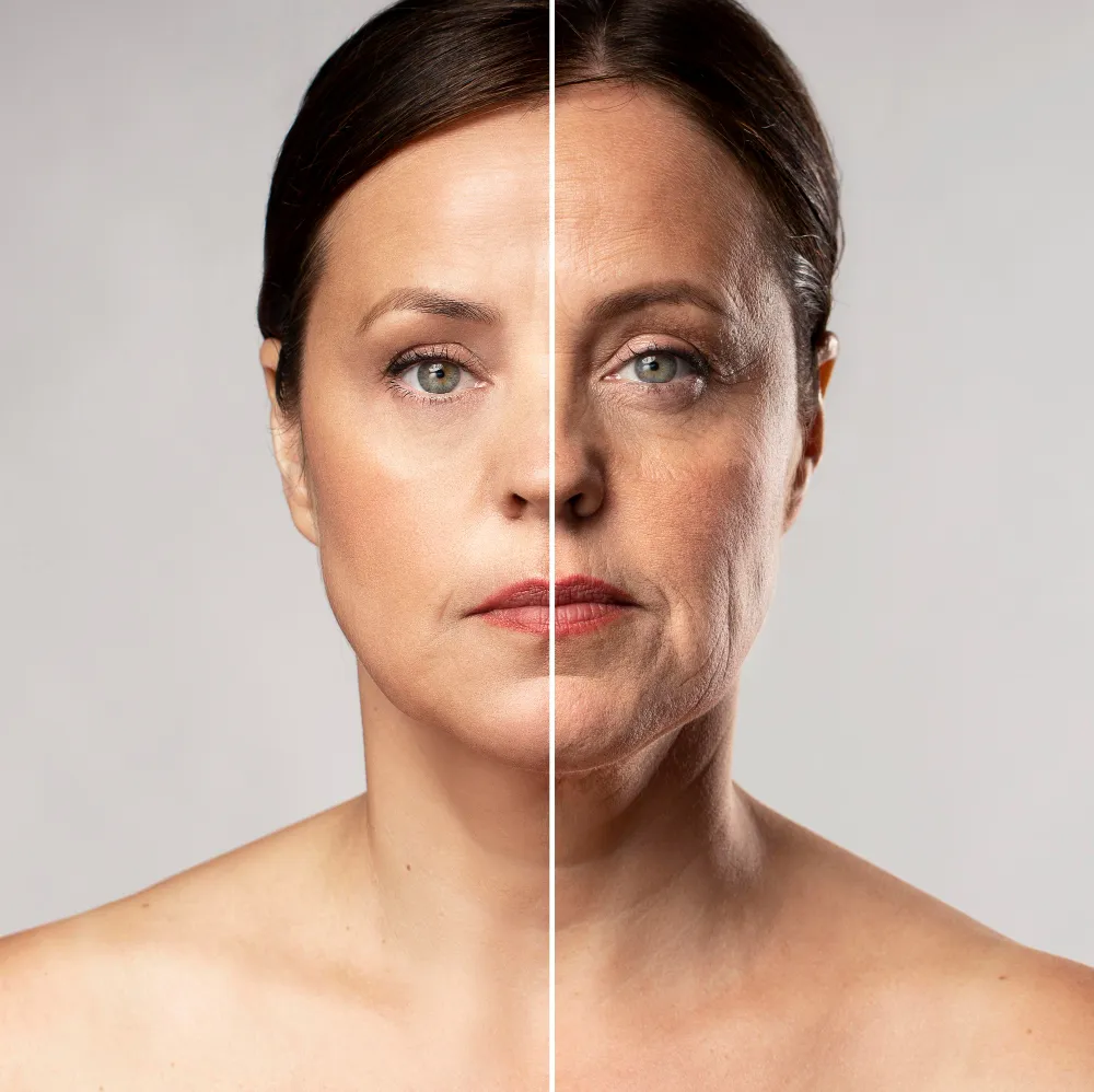 before after profhilo treatment mature woman algarve